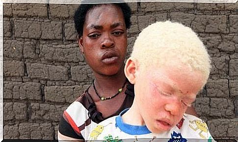 Black person behind an albino.